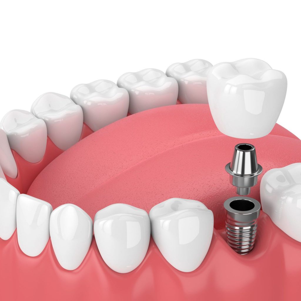 proceso de implante dental